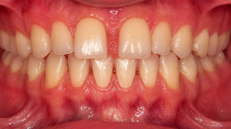 Ceramic Crowns — after
