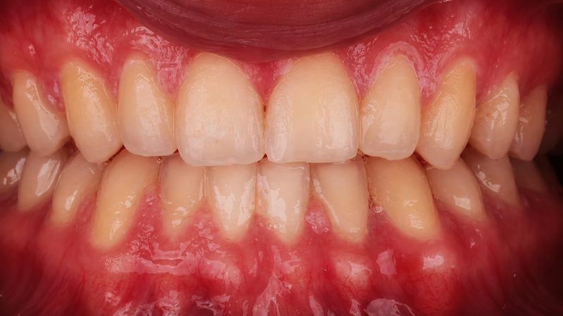 Ceramic Crowns — before