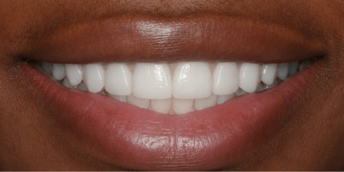 Cosmetic Dentistry — after