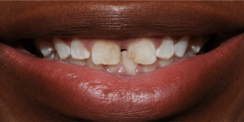 Cosmetic Dentistry — before