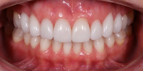 Teeth Whitening — after