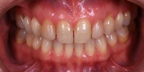 Teeth Whitening — before